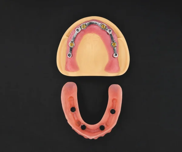 Bar retained overdenture img3