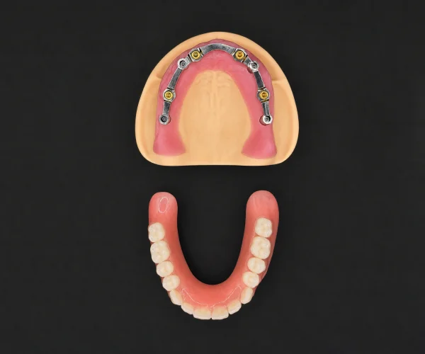 Bar retained overdenture img4