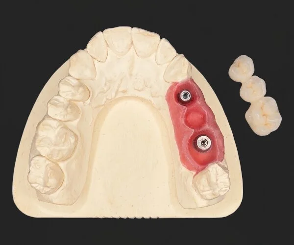 Cement retained implant crowns image1