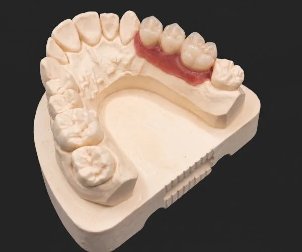 Cement retained implant crowns image3