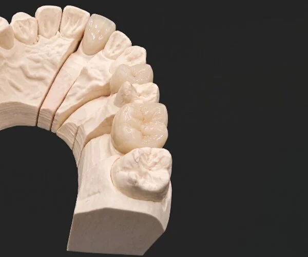 Crowns and bridges - layered zirconia