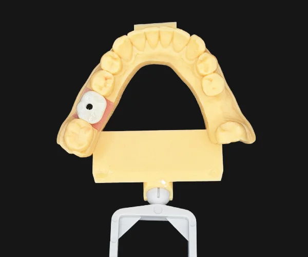 Implant screw retained img1
