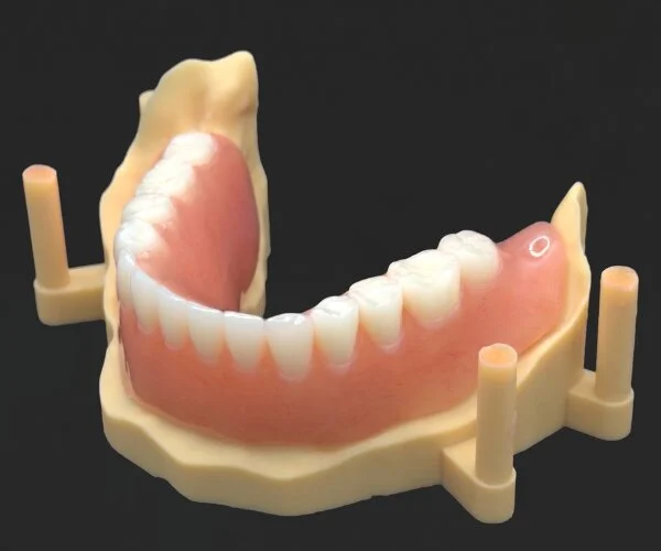 Partial dentures immediate denture over implant image1