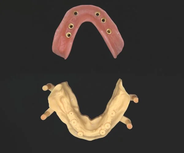 Partial dentures immediate denture over implant image2