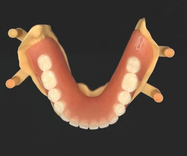 Partial dentures immediate denture over implant image3