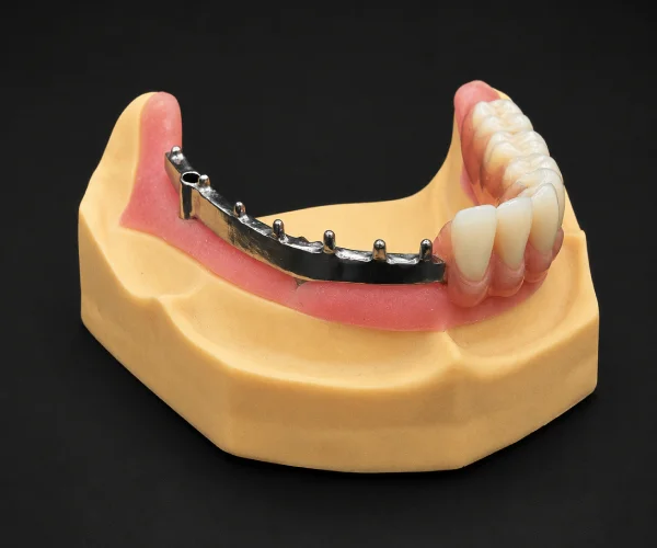 Titanium hybrid bar supported overdenture img1