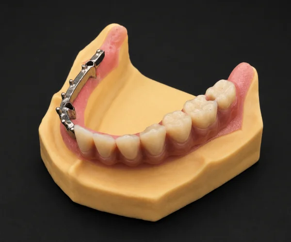 Titanium hybrid bar supported overdenture img2